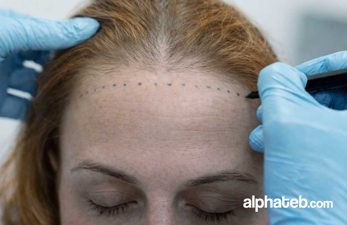 زراعة الشعر للنساء في تركيا