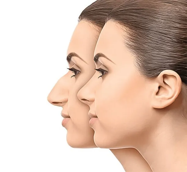 طرق تجميل الأنف