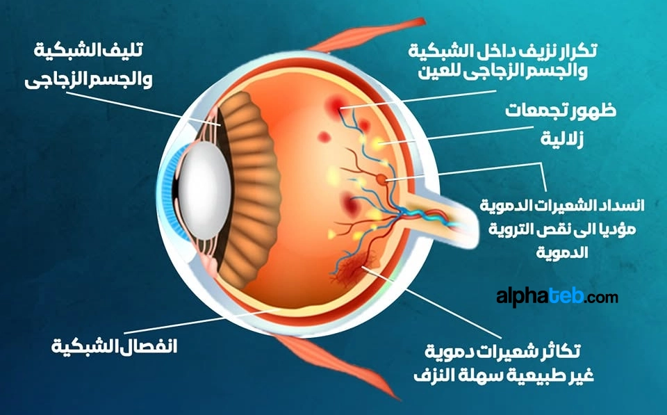 أعراض اعتلال الشبكية السكري