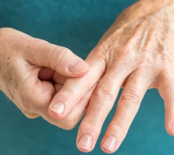 التهاب المفاصل الصدفي: الأسباب والأعراض
