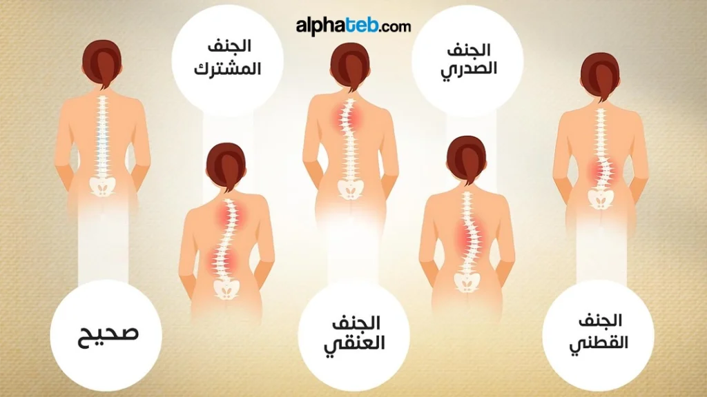 درجات الجنف عند البالغين