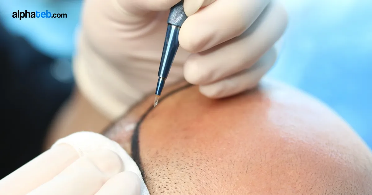تقنية سفير لزراعة الشعر | التكلفة والمميزات والنتائج