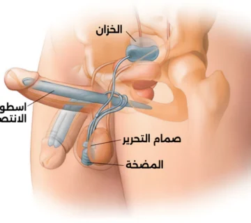 دعامة الانتصاب  أنواعها ومميزاتها وخطوات العملية