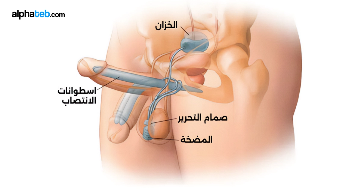 دعامة الانتصاب  أنواعها ومميزاتها وخطوات العملية