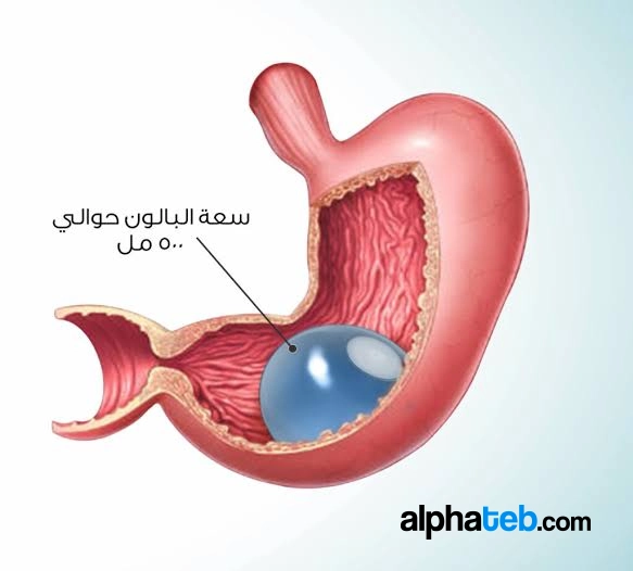 دليل عملية بالون المعدة في تركيا- المميزات