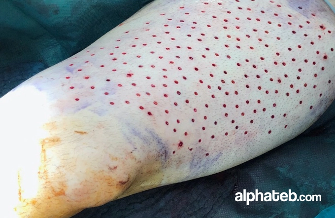 زراعة الجلد في تركيا