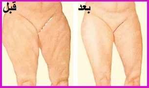 نتائج عملية شد الفخذ