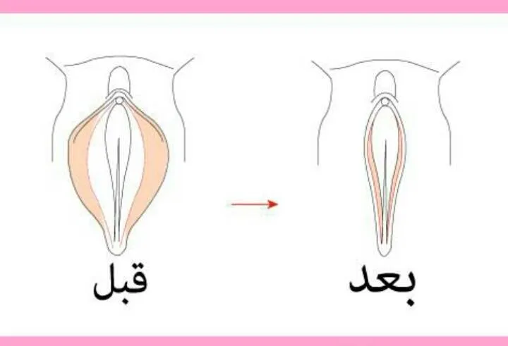 بدائل عملية تجميل المهبل