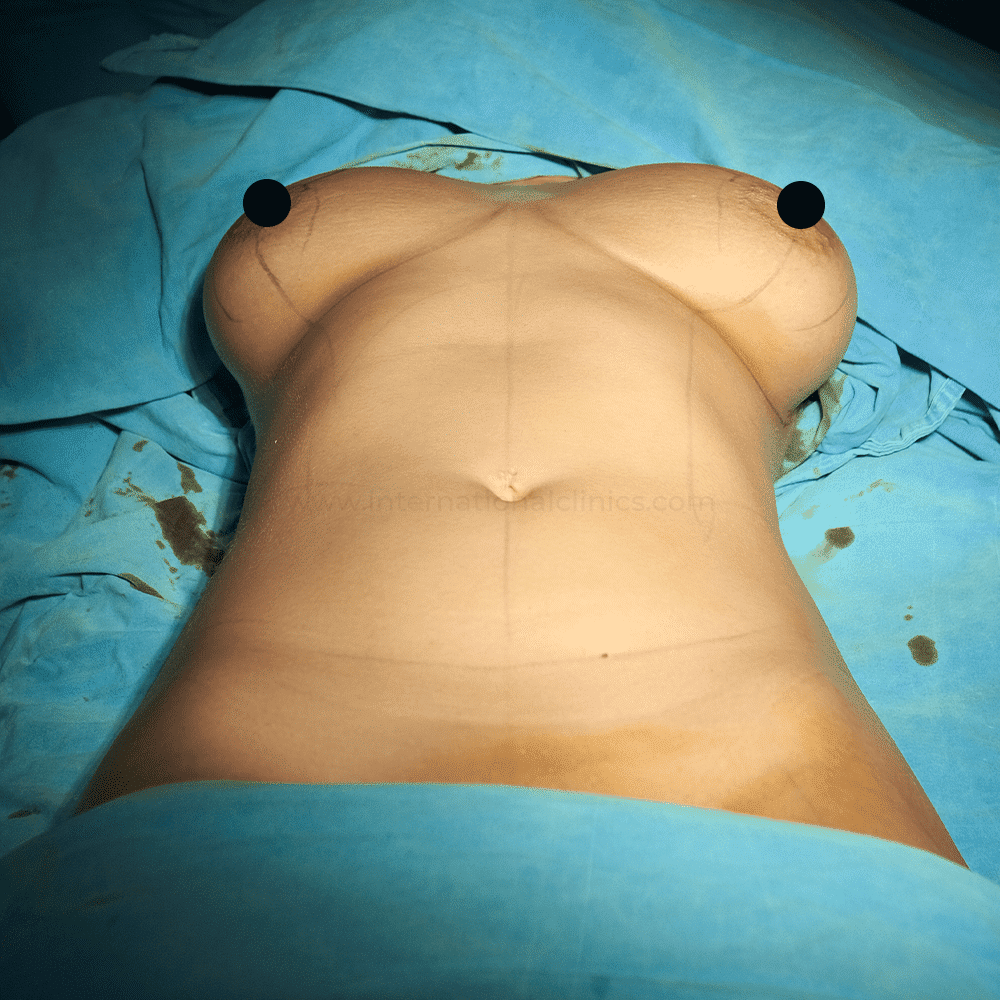 Mamoplasty before 1 2 مميزات وعيوب عملية شفط الدهون