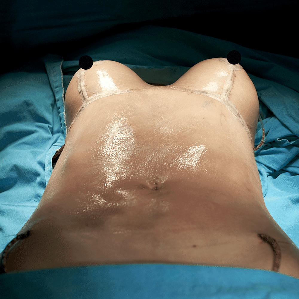 Mamoplasty after 1 مميزات وعيوب عملية شفط الدهون