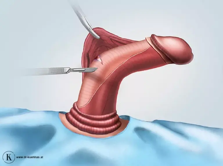 تجميل الأعضاء التناسلية الذكرية