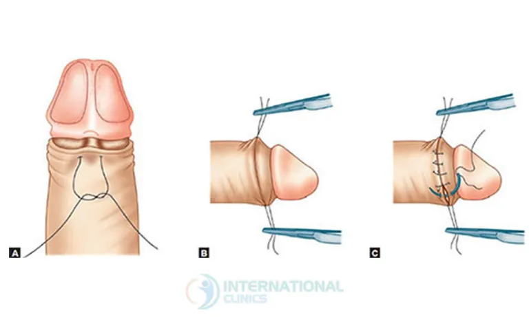 تجميل الأعضاء التناسلية الذكرية