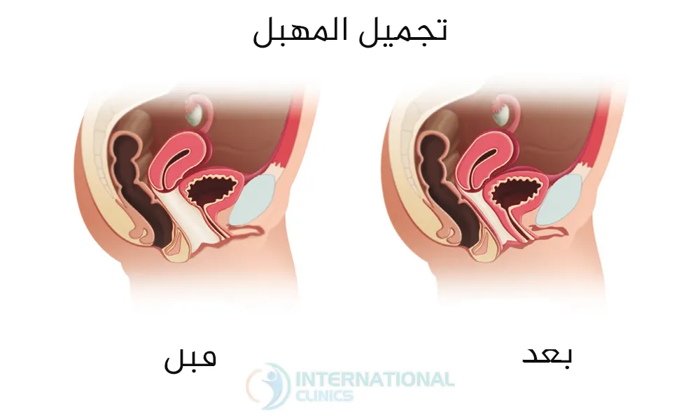 عمليات تجميل المهبل في تركيا