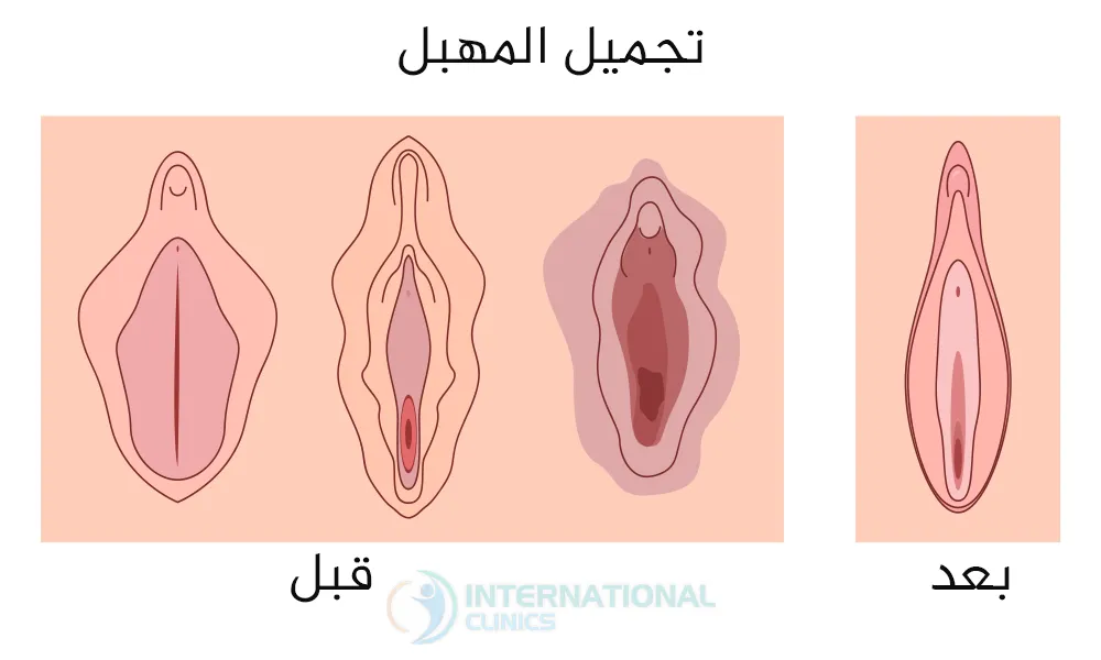 عمليات تجميل المهبل في تركيا