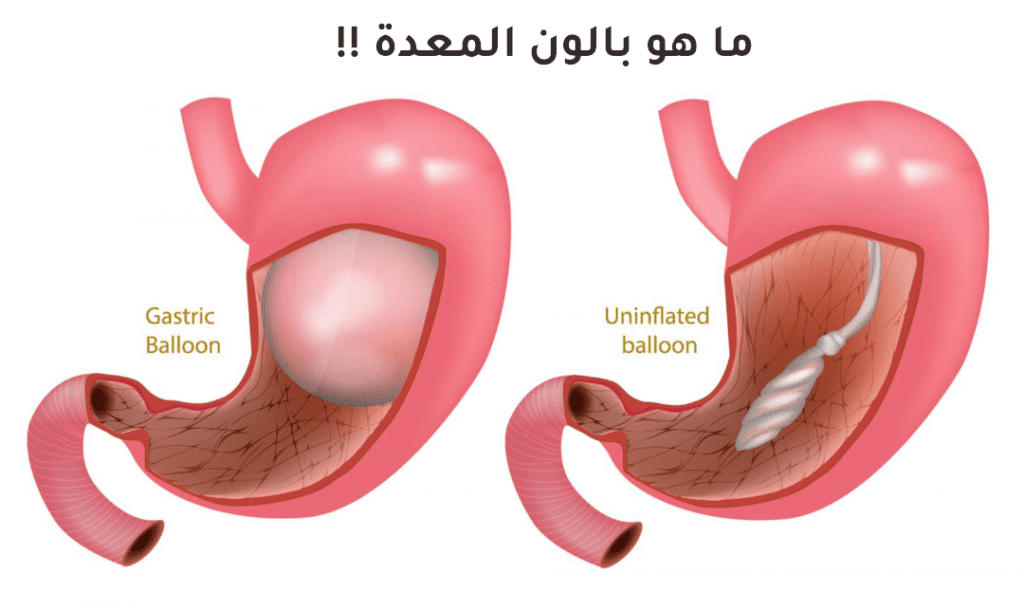 بالون المعدة أسباب السمنة