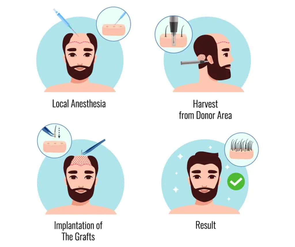 تقنيات زراعة الشعر المتطورة