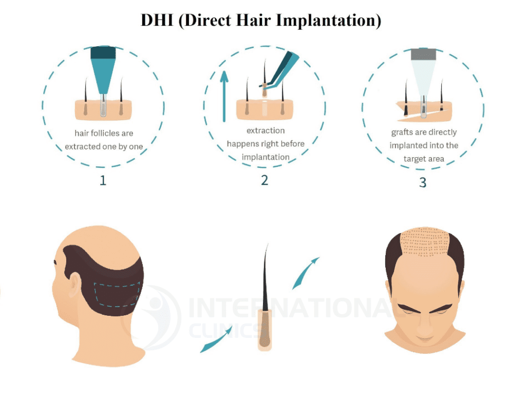 تقنية الاقتطاف لزراعة الشعر