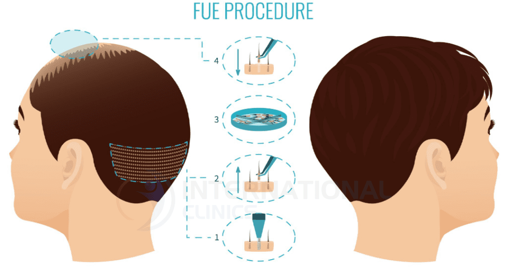 تقنية السفير في زراعة الشعر