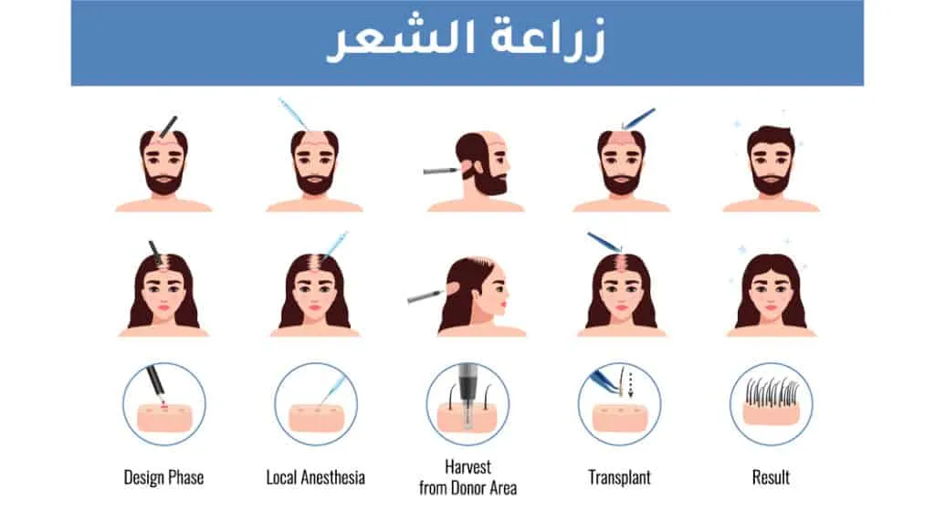 تقنية سفير لزراعة الشعر