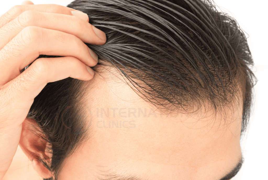 تقنية سفير لزراعة الشعر