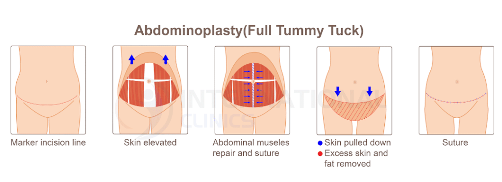 مميزات عمليات تجميل البطن في تركيا