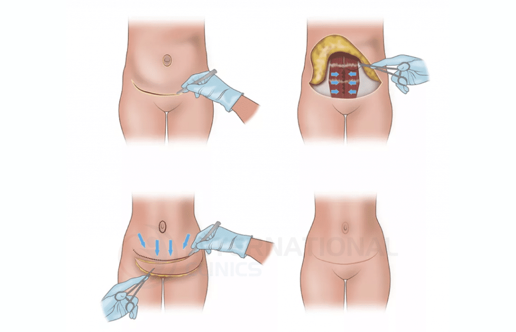 مميزات عمليات تجميل البطن في تركيا