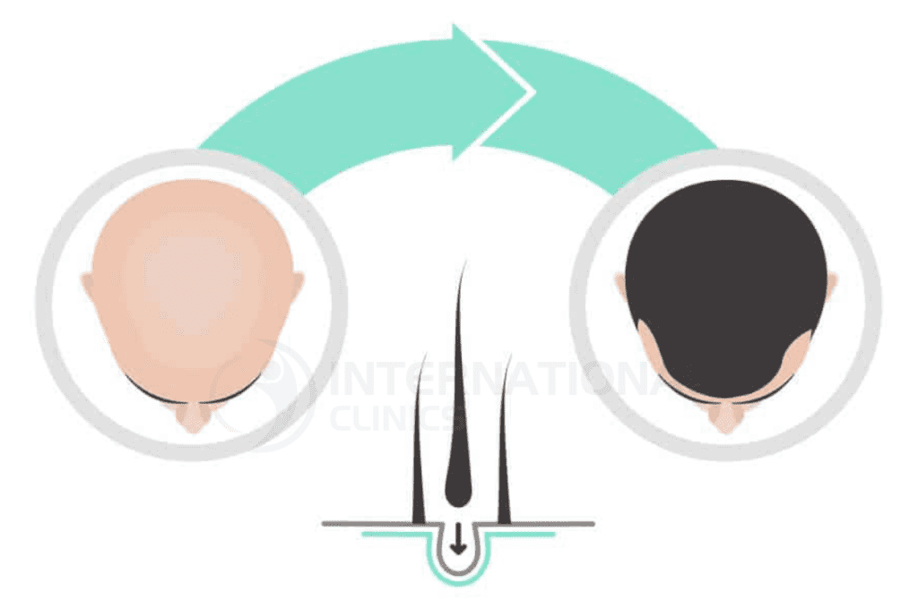 مراحل زراعة عملية الشعر بتقنية الإقتطاف