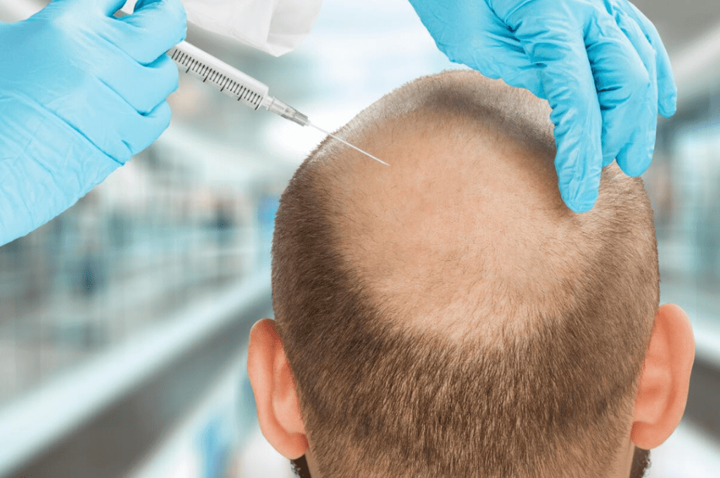عملية زراعة الشعر