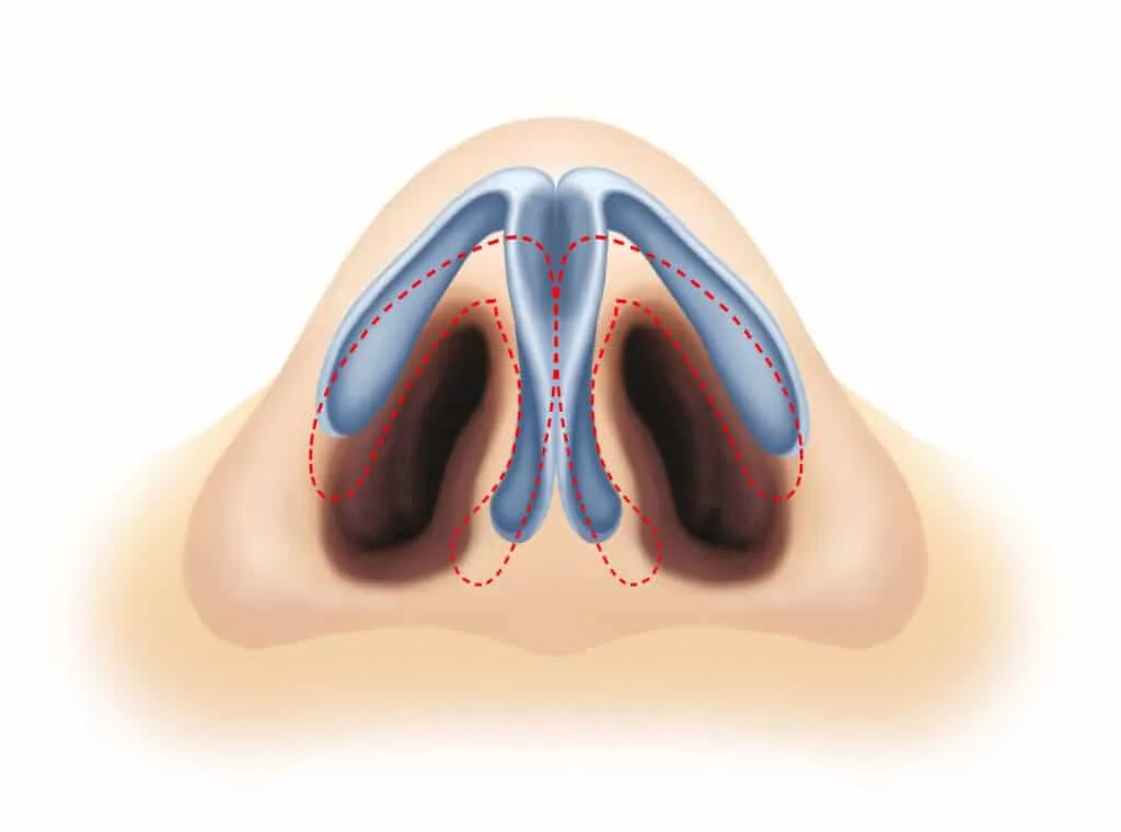تجميل الأنف الافطس