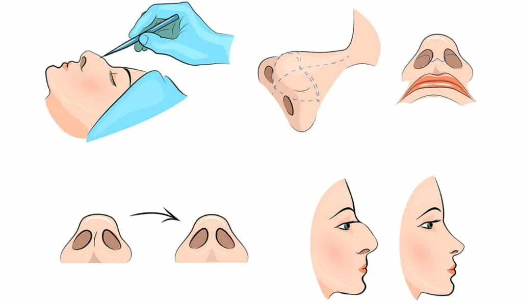 تجميل الأنف الافطس