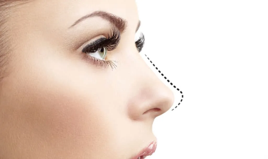 عملية تجميل الأنف الارنبة