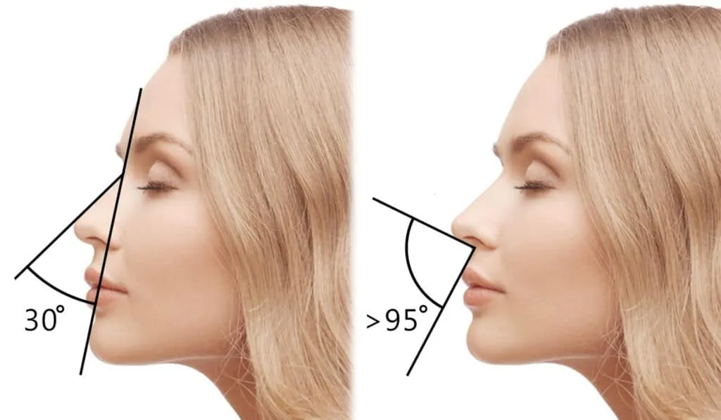 تجميل الأنف بالخيوط الذهبية