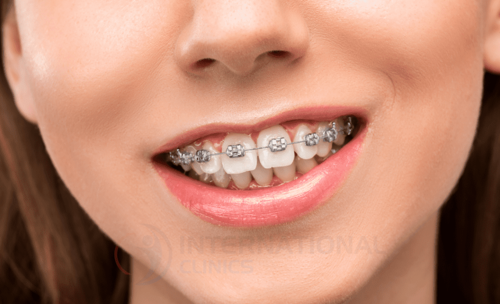 يتم تصميم جهاز التقويم بما يتوائم مع مقاييس الخاصة بأسنان المريض