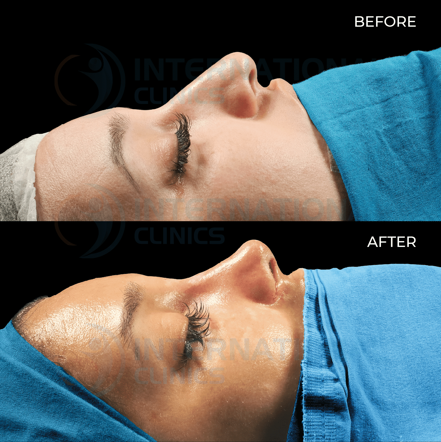 تجربتي مع عملية تجميل الأنف