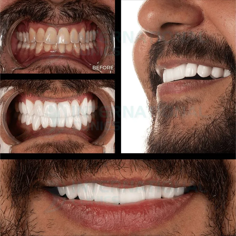 تبييض الأسنان بالليزر قبل وبعد