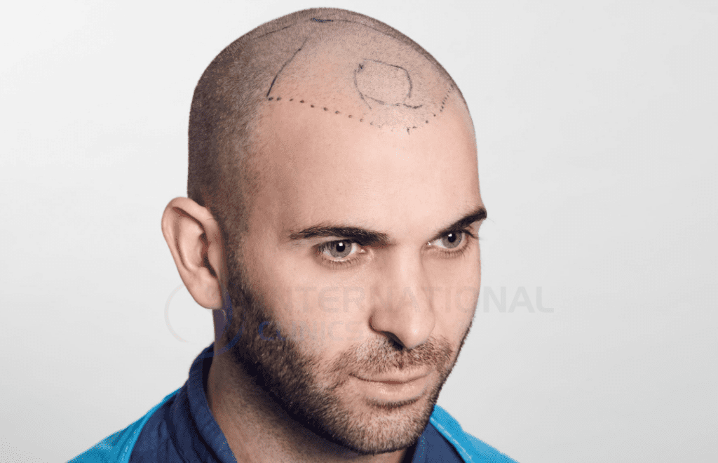 المنطقة المانحة بعد الزراعة