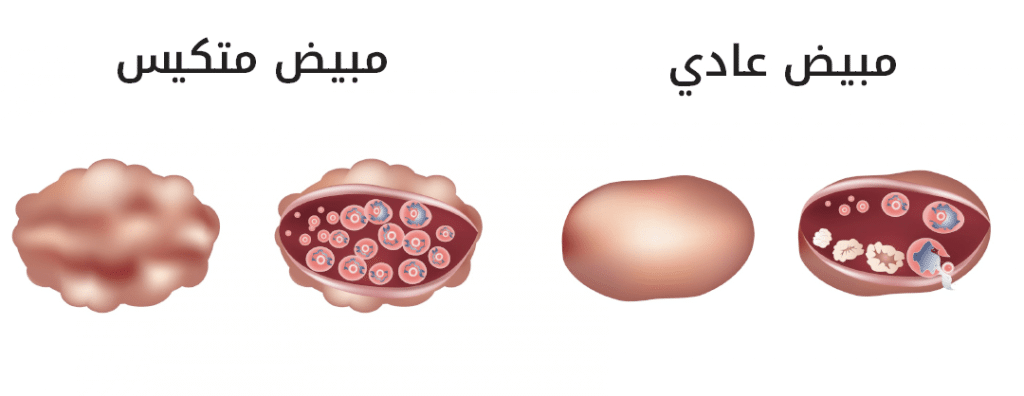 الفرق بين أكياس المبيض وتكيس المبايض