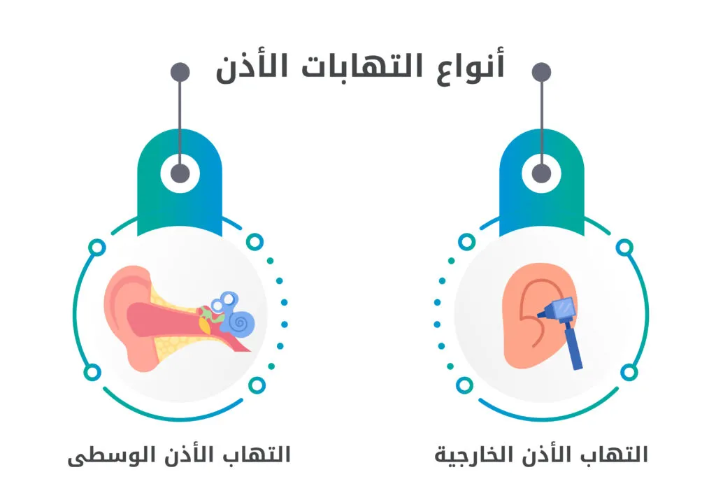 التهاب الأذن الوسطى