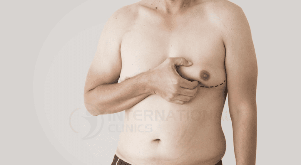 أعراض التثدي عند الرجال !!