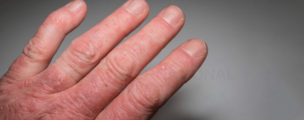 أمراض المناعة الذاتية