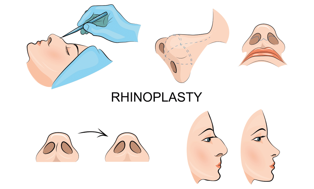 أسعار عملية تجميل الأنف