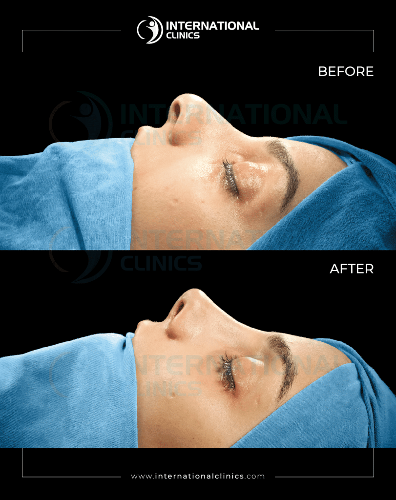 أسباب فشل عملية تجميل الأنف