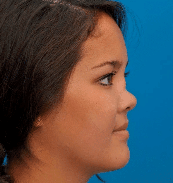 أسباب فشل عملية تجميل الأنف