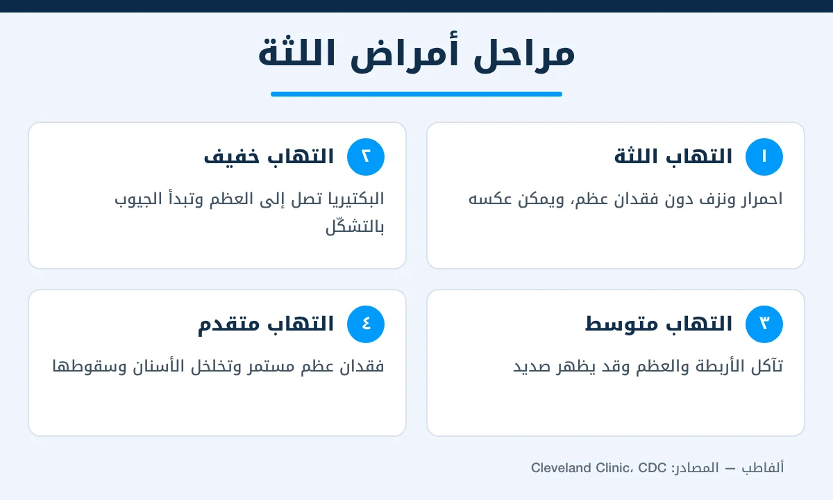 إنفوغرافيك يوضح 4 مراحل لتطور أمراض اللثة من التهاب اللثة إلى التهاب دواعم السن المتقدم