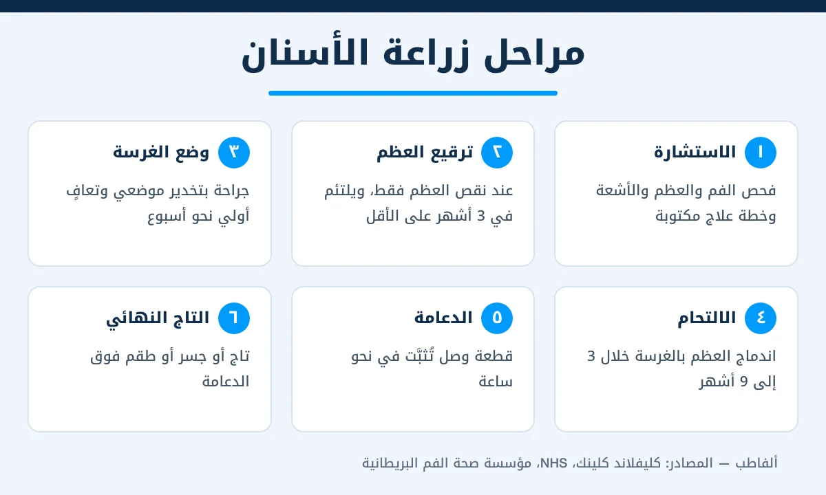 إنفوجرافيك مراحل زراعة الأسنان من الاستشارة وترقيع العظم إلى الالتحام والتاج النهائي