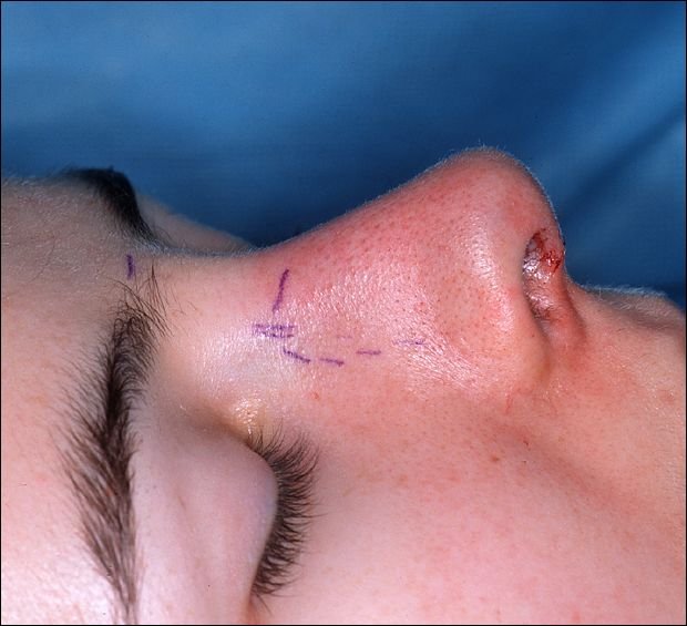 أنف مريض في نهاية عملية تجميل الأنف قبل وضع الجبيرة