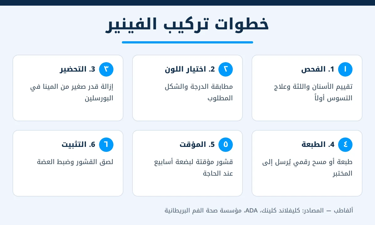 خطوات تركيب فينير الأسنان من الفحص إلى التثبيت