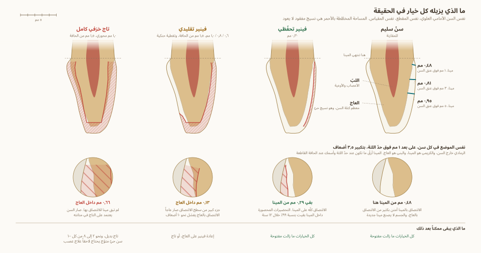 مقارنة مقدار ما يُزال من السن في فينير الأسنان التقليدي والتحفظي والتاج الكامل
