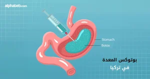 بوتوكس في المعدة في تركيا: الخطوات والفوائد والأسعار