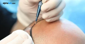 تقنية سفير لزراعة الشعر | التكلفة والمميزات والنتائج